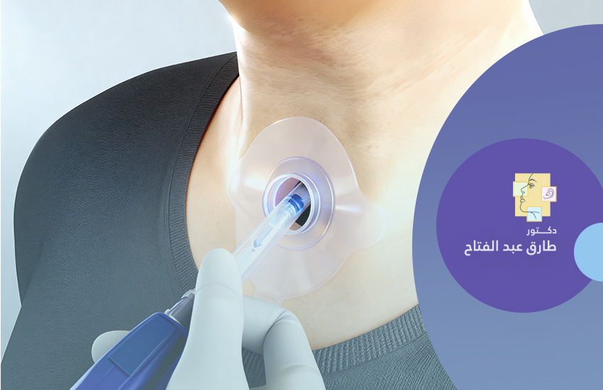 تغيير صمام الكلام بعد حالات إستئصال الحنجرة